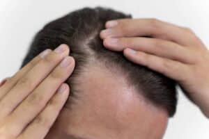 Hair mesotherapy in Istanbul